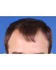 Before Hair Transplant&nbsp;Hairlines